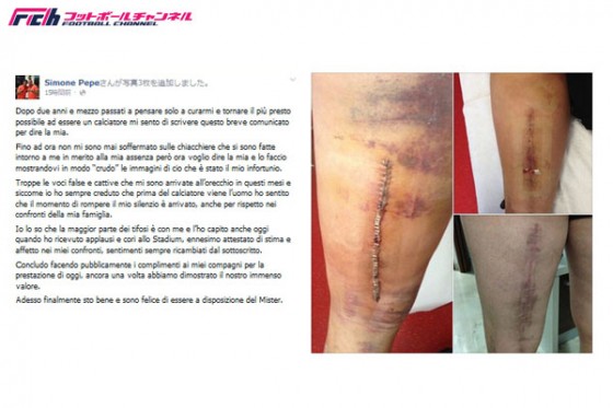 ユベントスのMFペペが自らの手術跡をフェイスブックに投稿。"怠慢"の噂に反論